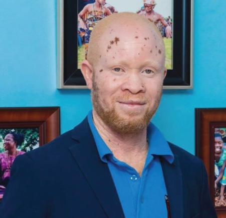 Kwame Andrews Daklo, Albinism Programme Coordinator at Engage Now Africa Kwame Andrews Daklo, Albinism Programme Coordinator at Engage Now Africa