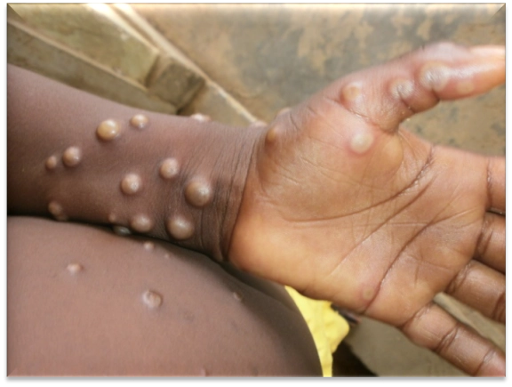 Mpox cases in Ghana rise to 108