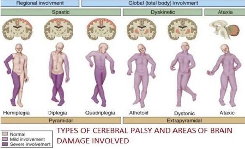 Cerebral Palsy