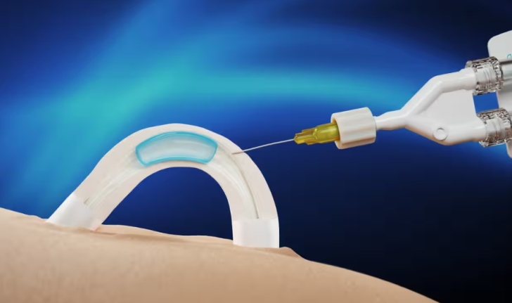 The company behind the product said the implant was inserted in a minimally invasive procedure that took about 10 minutes and used local anaesthetic. Photograph: Contraline The company behind the product said the implant was inserted in a minimally invasive procedure that took about 10 minutes and used local anaesthetic. Photograph: Contraline