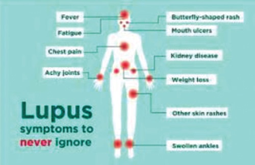 Living with lupus: Battle fought in silence, story of survival