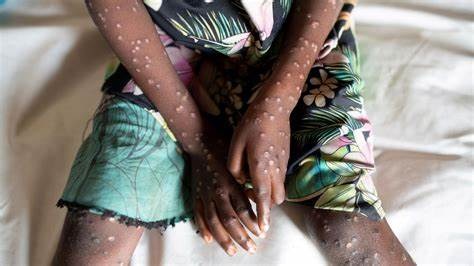 Ghana confirms 10 new Mpox cases, total rises to 19