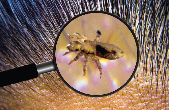 Head louse