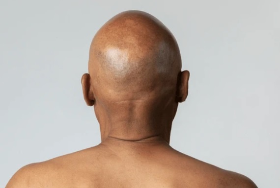 Baldness breakthrough: Serum regrows hair in 20 days Baldness breakthrough: Serum regrows hair in 20 days