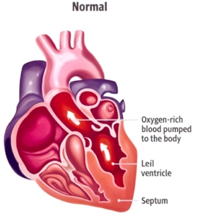 A call to action: Silent crisis of heart failure 