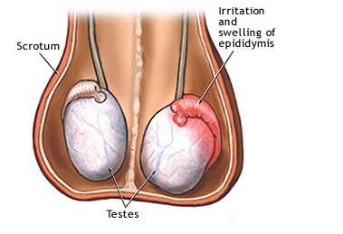 What causes scrotal swelling?