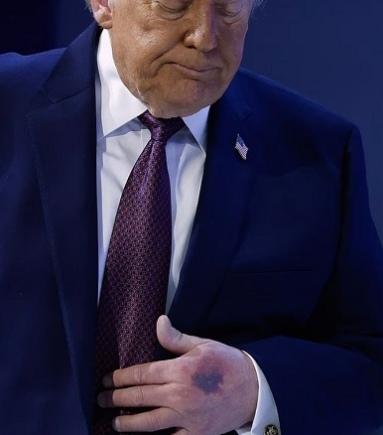 US President Donald Trump has sparked public concern after a noticeable bruise was seen on his left hand