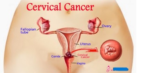 Low vaccination, poor screening fuel  cervical cancer burden — Dr Aisha Ali Issaka