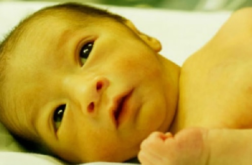 Any baby with untreated severe jaundice is at risk of brain damage from the jaundice