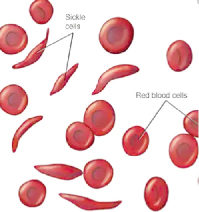 World Sickle Cell Awareness Day