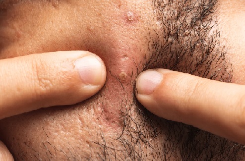 Squeezing facial boils can spread infection to the brain