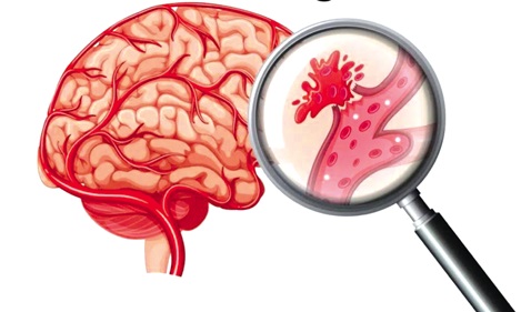A rupture of the vessel causing hemorrhagic stroke in the brain