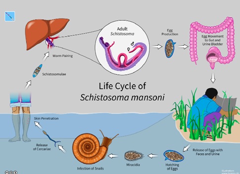 Silent killer in water: Schistosomiasis: Preventable disease threatening children