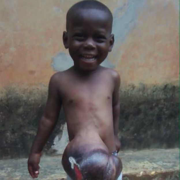 In the UK exomphalos is usually treated within 24 hours of birth