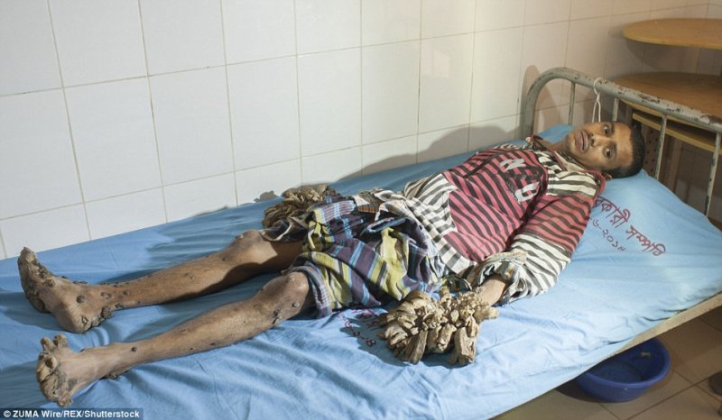 Tree Man - Getting ready for surgery