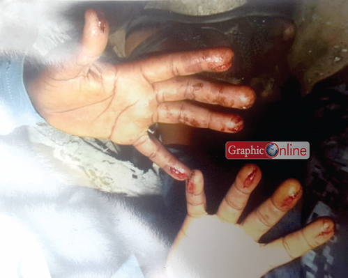 The blood-stained fingers of the boy