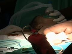 Second separated Siamese twin also dies