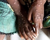 Ghana record  21 new Mpox cases, total now at 218