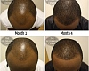 LIBRARY PHOTO: An example of male pattern hair loss client's success story