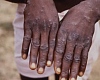Ghana confirms 16 new Mpox cases as total rises to 234