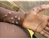 Ghana confirms two new Mpox cases; total rises to four