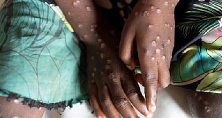 Ghana record  21 new Mpox cases, total now at 218