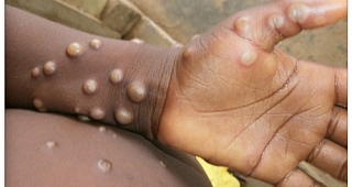 Ghana confirms two new Mpox cases; total rises to four